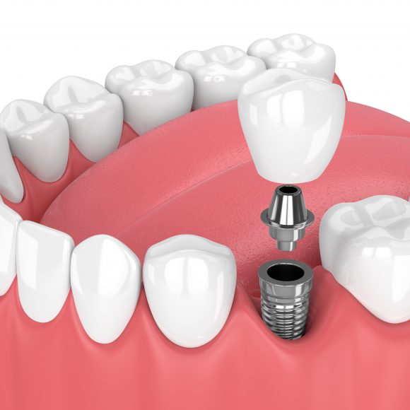 Szájsebészet, implantológia