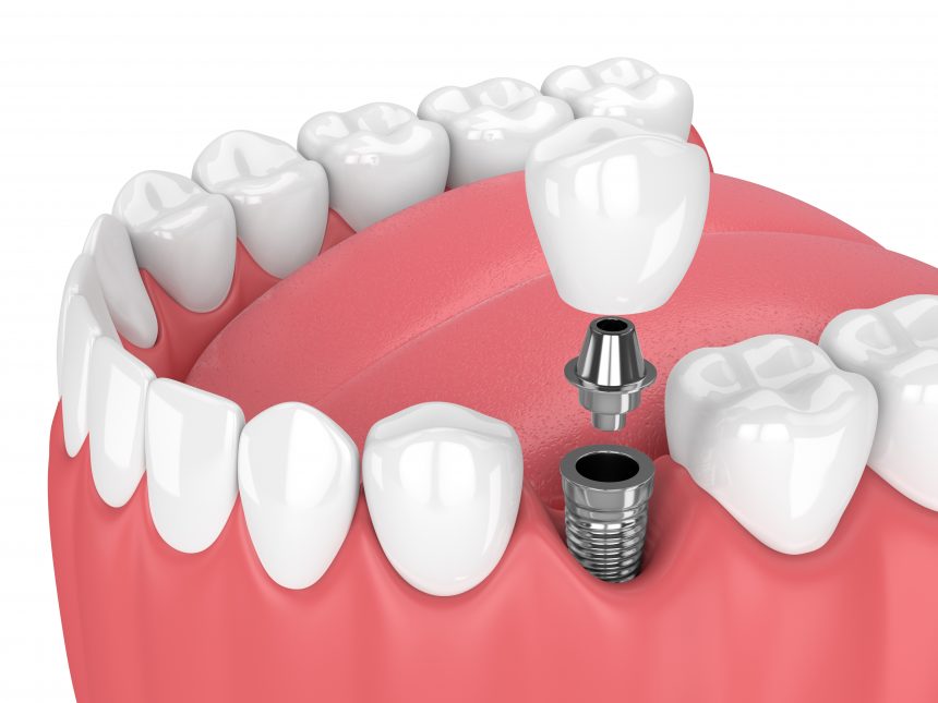 Szájsebészet, implantológia